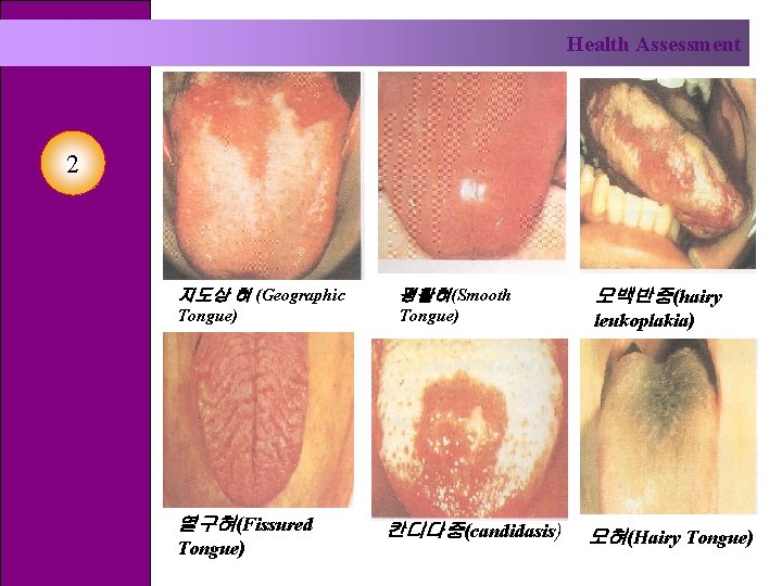 Health Assessment 2 지도상 혀 (Geographic 평활혀(Smooth Tongue) 열구혀(Fissured Tongue) 칸디다증(candidasis) 모백반증(hairy leukoplakia) 모혀(Hairy