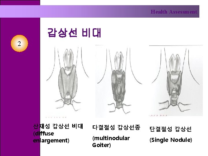 Health Assessment 갑상선 비대 2 산재성 갑상선 비대 (diffuse enlargement) 다결절성 갑상선종 단결절성 갑상선