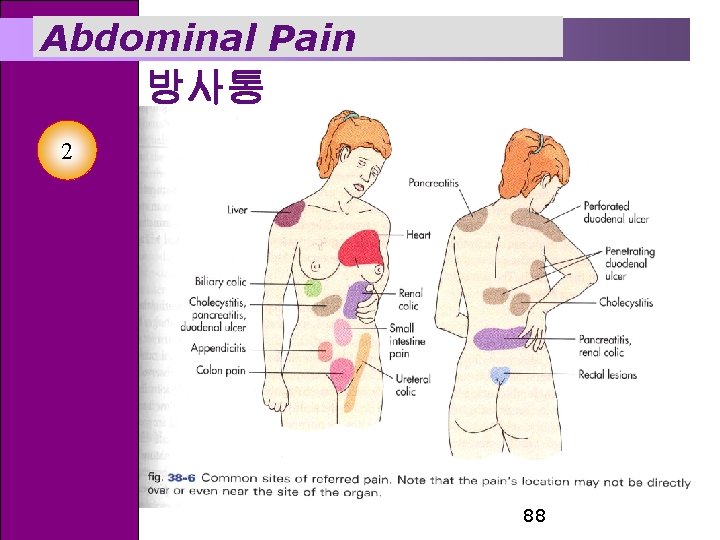 Abdominal Pain 방사통 2 88 
