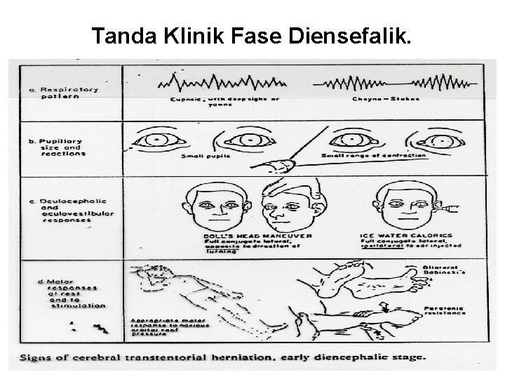 Tanda Klinik Fase Diensefalik. 