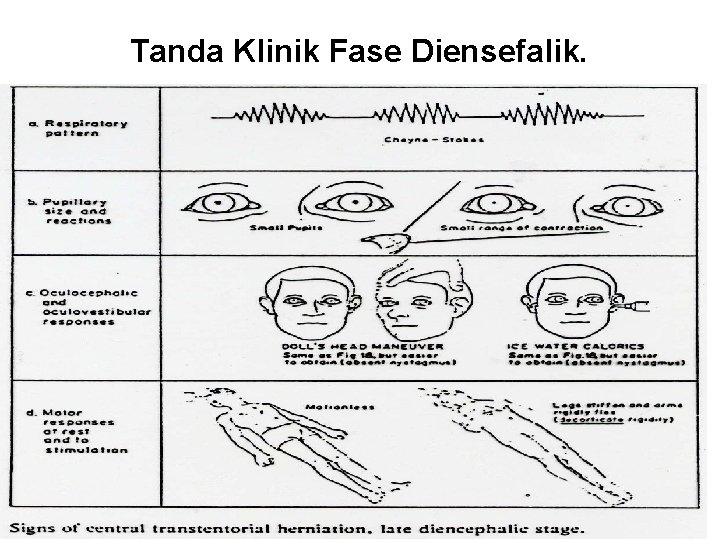 Tanda Klinik Fase Diensefalik. 