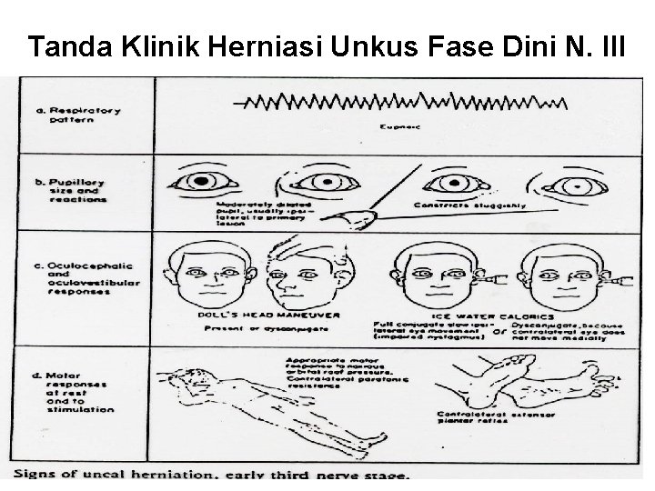 Tanda Klinik Herniasi Unkus Fase Dini N. III 