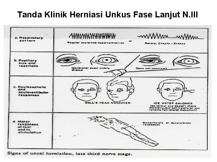 Tanda Klinik Herniasi Unkus Fase Lanjut N. III 