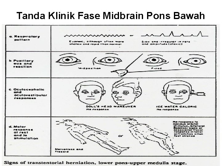 Tanda Klinik Fase Midbrain Pons Bawah 