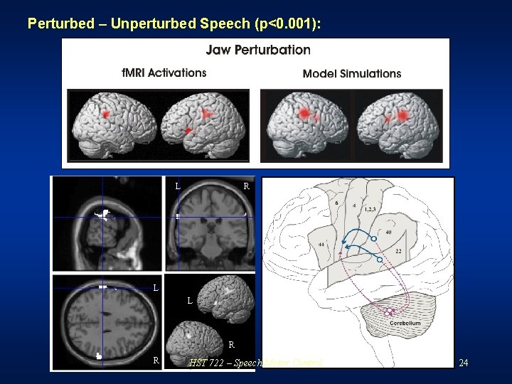 Perturbed – Unperturbed Speech (p<0. 001): L R L L R R HST 722