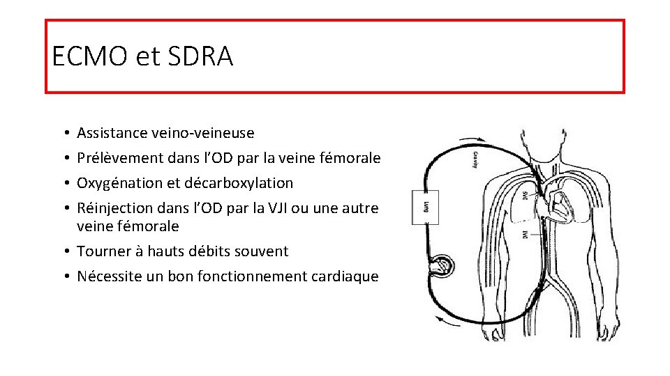 ECMO et SDRA Assistance veino-veineuse Prélèvement dans l’OD par la veine fémorale Oxygénation et