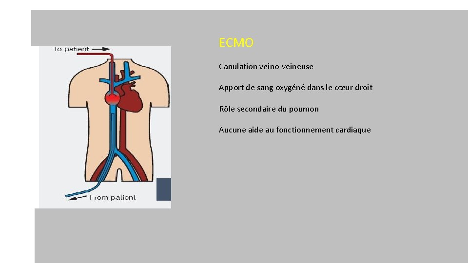 ECMO Canulation veino-veineuse Apport de sang oxygéné dans le cœur droit Rôle secondaire du