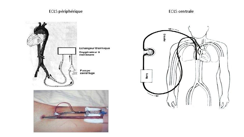 ECLS périphérique ECLS centrale 