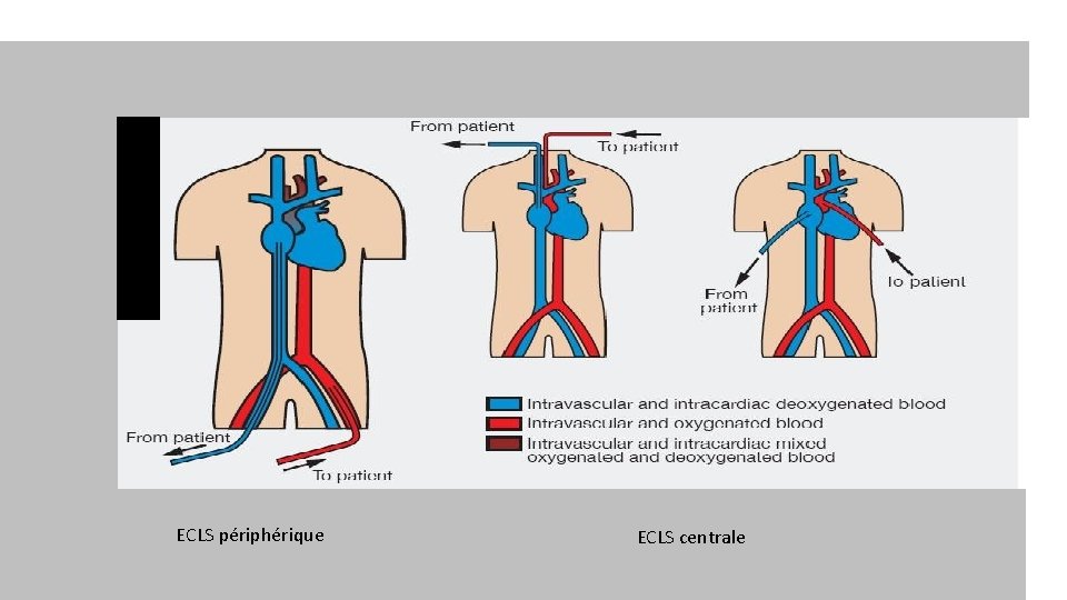 ECLS périphérique ECLS centrale 