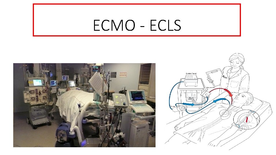 ECMO - ECLS 