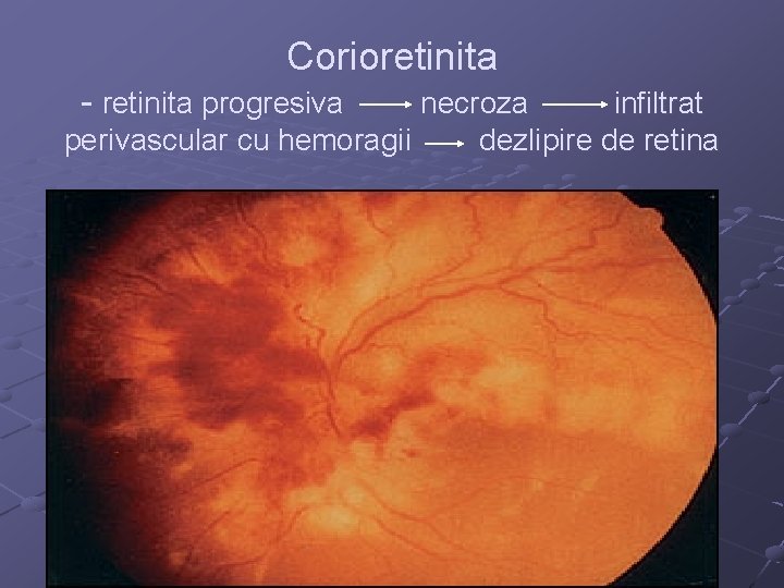 Corioretinita - retinita progresiva necroza infiltrat perivascular cu hemoragii dezlipire de retina 