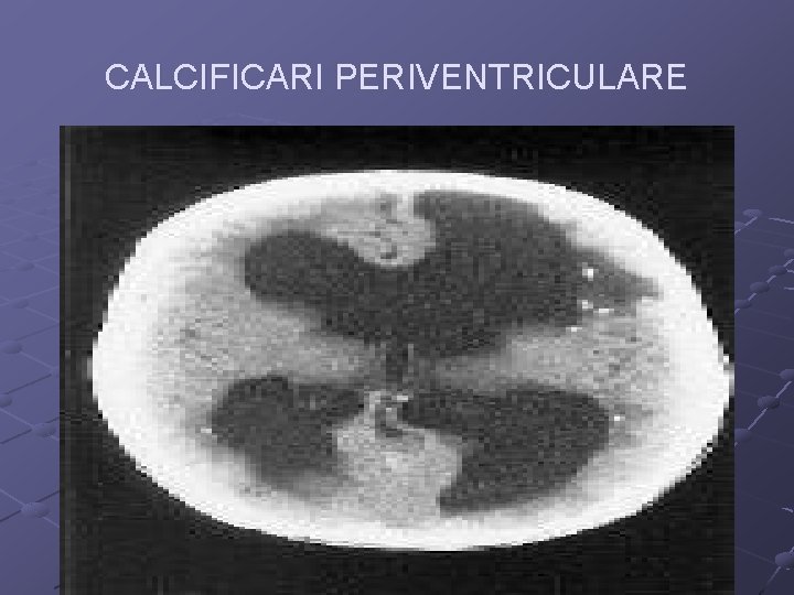 CALCIFICARI PERIVENTRICULARE 