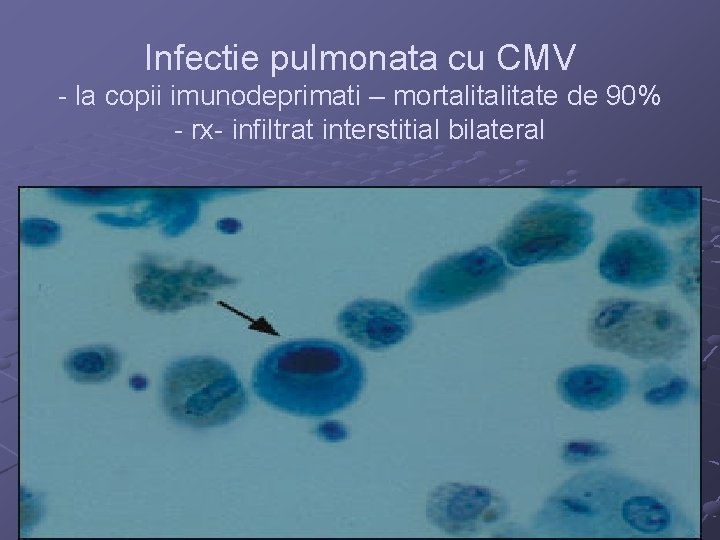 Infectie pulmonata cu CMV - la copii imunodeprimati – mortalitate de 90% - rx-