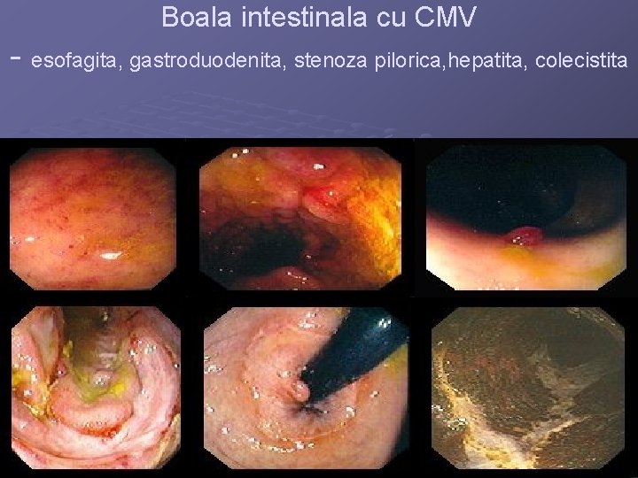 Boala intestinala cu CMV - esofagita, gastroduodenita, stenoza pilorica, hepatita, colecistita 