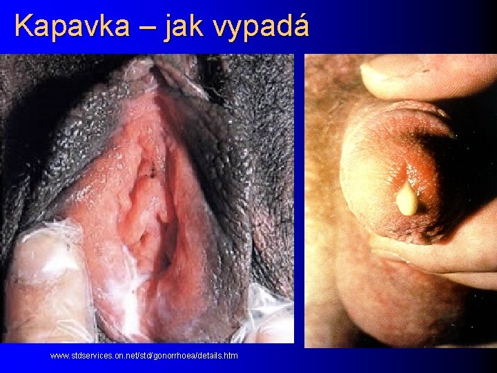 Kapavka – jak vypadá www. stdservices. on. net/std/gonorrhoea/details. htm 