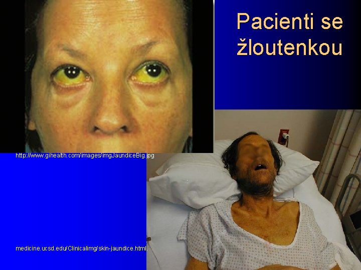 Pacienti se žloutenkou http: //www. gihealth. com/images/img. Jaundice. Big. jpg medicine. ucsd. edu/Clinicalimg/skin-jaundice. html.