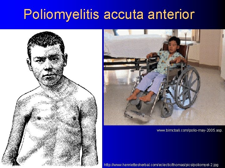 Poliomyelitis accuta anterior www. bimcbali. com/polio-may-2005. asp. http: //www. henriettesherbal. com/eclectic/thomas/pics/poliomyel-2. jpg 