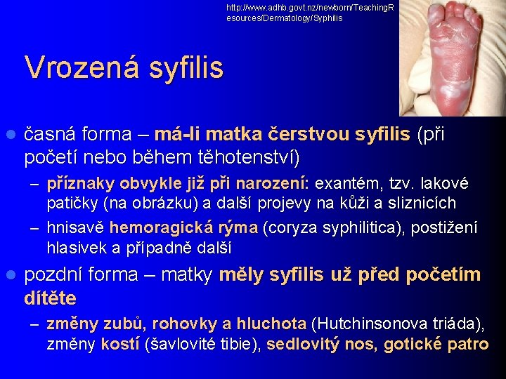 http: //www. adhb. govt. nz/newborn/Teaching. R esources/Dermatology/Syphilis Vrozená syfilis l časná forma – má-li