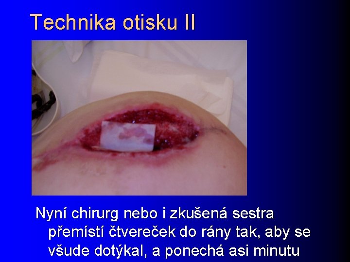 Technika otisku II Nyní chirurg nebo i zkušená sestra přemístí čtvereček do rány tak,