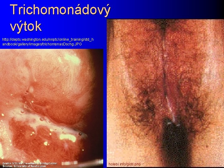 Trichomonádový výtok http: //depts. washington. edu/nnptc/online_training/std_h andbook/gallery/images/trichomonas. Dschg. JPG holebi. info/gids. php 