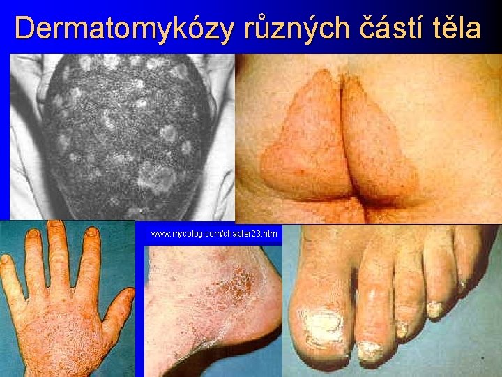 Dermatomykózy různých částí těla www. mycolog. com/chapter 23. htm 