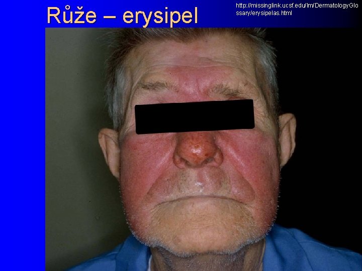 Růže – erysipel http: //missinglink. ucsf. edu/lm/Dermatology. Glo ssary/erysipelas. html 