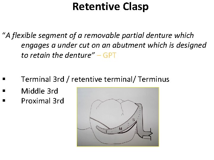 Retentive Clasp “A flexible segment of a removable partial denture which engages a under