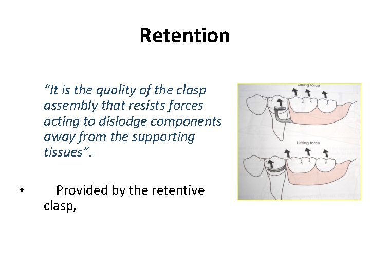 Retention “It is the quality of the clasp assembly that resists forces acting to