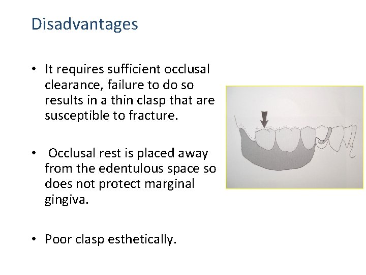 Disadvantages • It requires sufficient occlusal clearance, failure to do so results in a