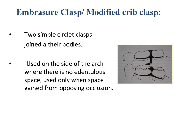 Embrasure Clasp/ Modified crib clasp: • Two simple circlet clasps joined a their bodies.