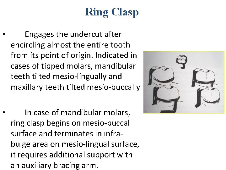 Ring Clasp • Engages the undercut after encircling almost the entire tooth from its