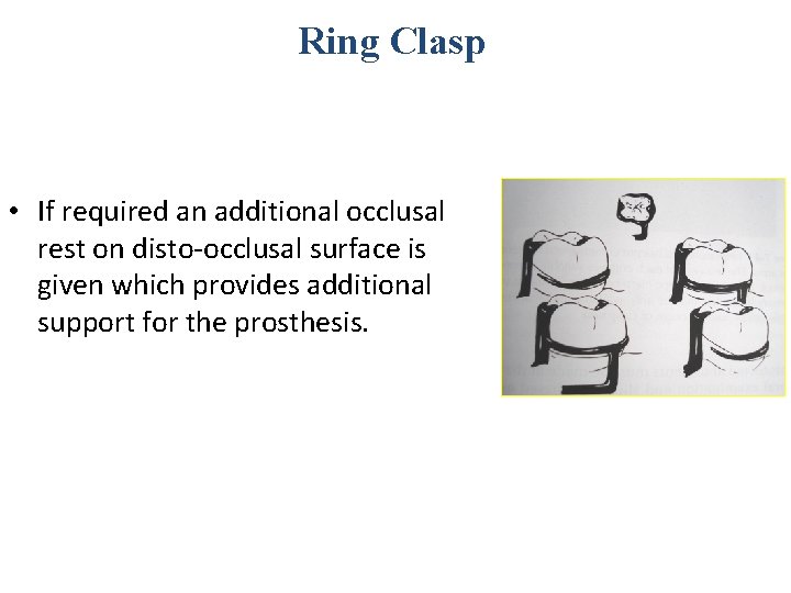 Ring Clasp • If required an additional occlusal rest on disto-occlusal surface is given