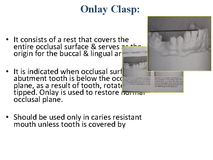 Onlay Clasp: • It consists of a rest that covers the entire occlusal surface