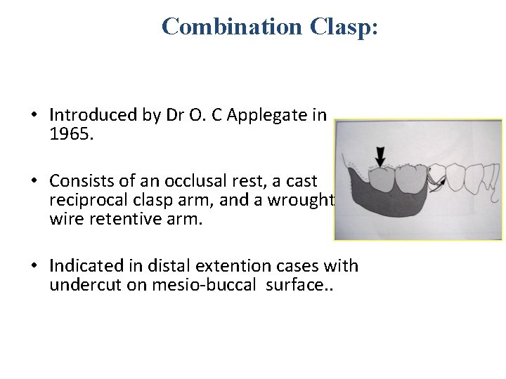 Combination Clasp: • Introduced by Dr O. C Applegate in 1965. • Consists of