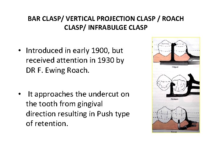 BAR CLASP/ VERTICAL PROJECTION CLASP / ROACH CLASP/ INFRABULGE CLASP • Introduced in early