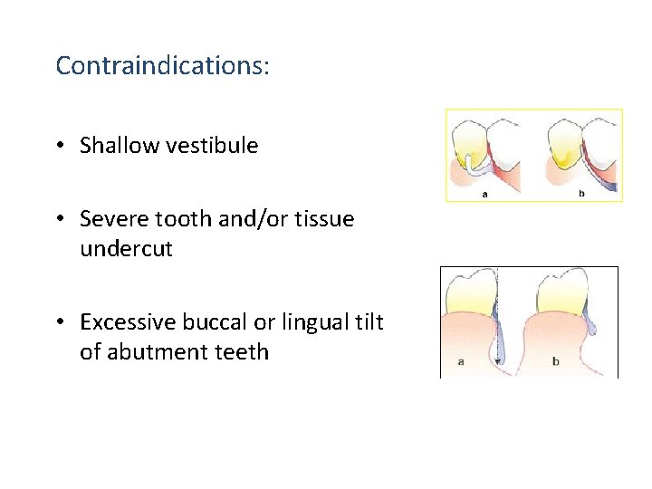 Contraindications: • Shallow vestibule • Severe tooth and/or tissue undercut • Excessive buccal or