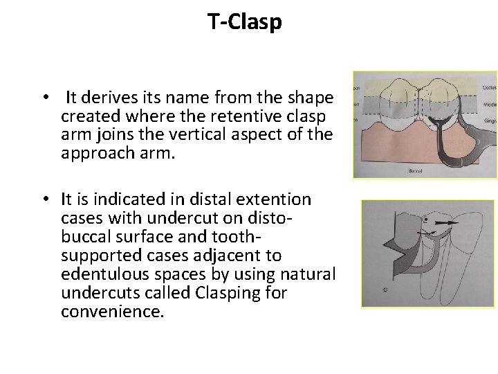 T-Clasp • It derives its name from the shape created where the retentive clasp