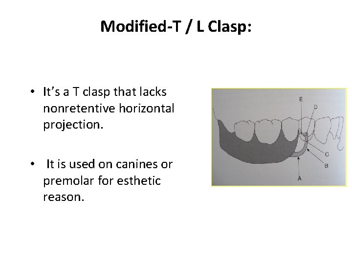 Modified-T / L Clasp: • It’s a T clasp that lacks nonretentive horizontal projection.
