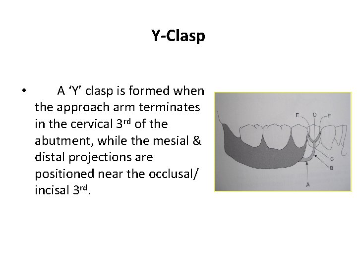 Y-Clasp • A ‘Y’ clasp is formed when the approach arm terminates in the