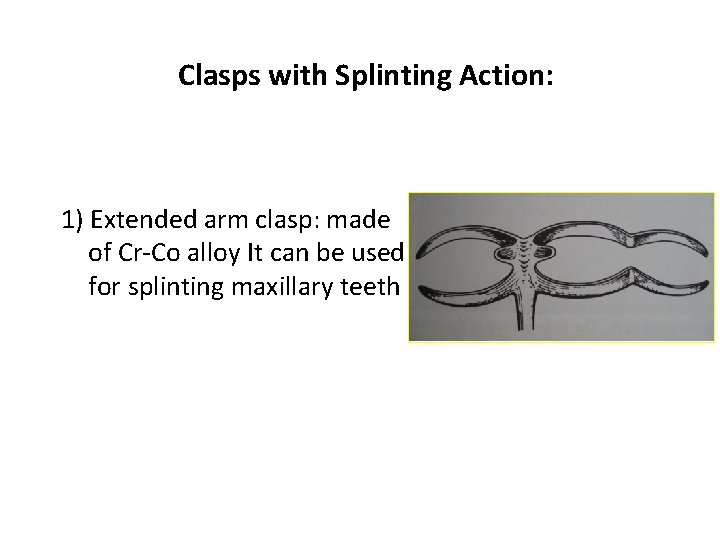 Clasps with Splinting Action: 1) Extended arm clasp: made of Cr-Co alloy It can