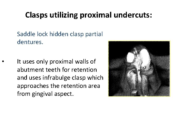 Clasps utilizing proximal undercuts: Saddle lock hidden clasp partial dentures. • It uses only