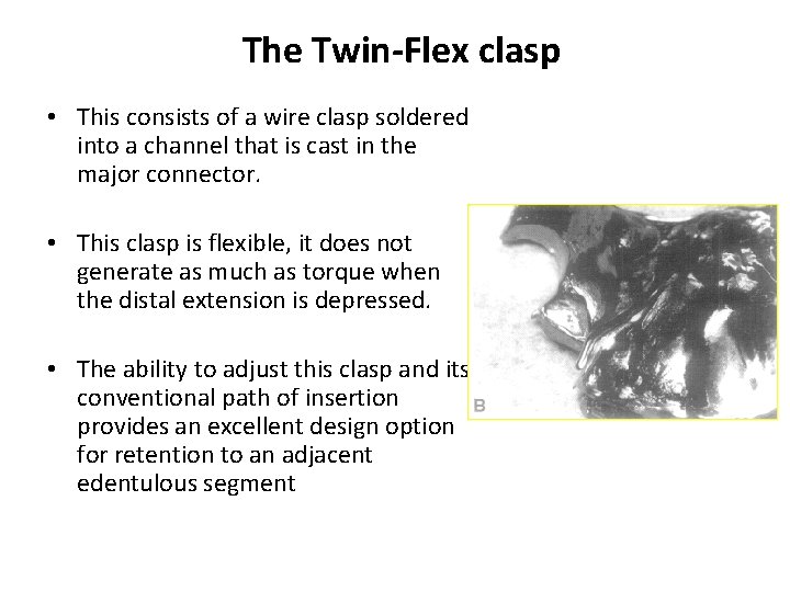 The Twin-Flex clasp • This consists of a wire clasp soldered into a channel