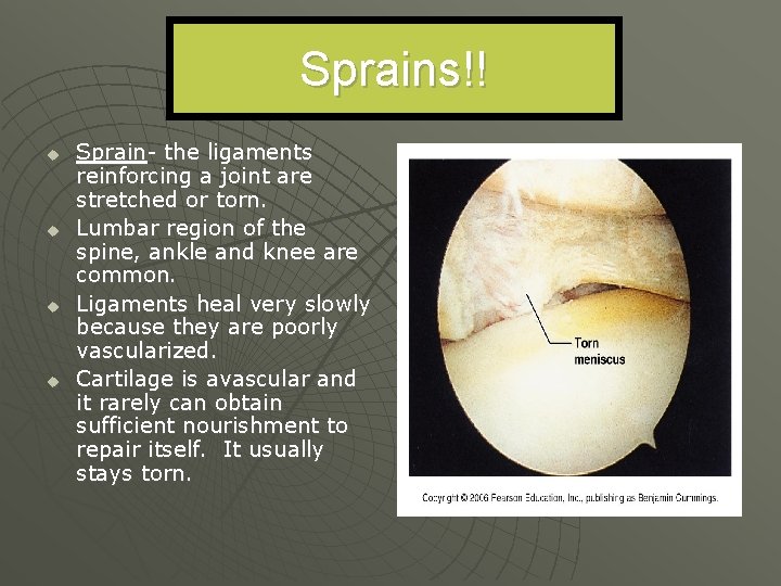 Sprains!! u u Sprain- the ligaments reinforcing a joint are stretched or torn. Lumbar