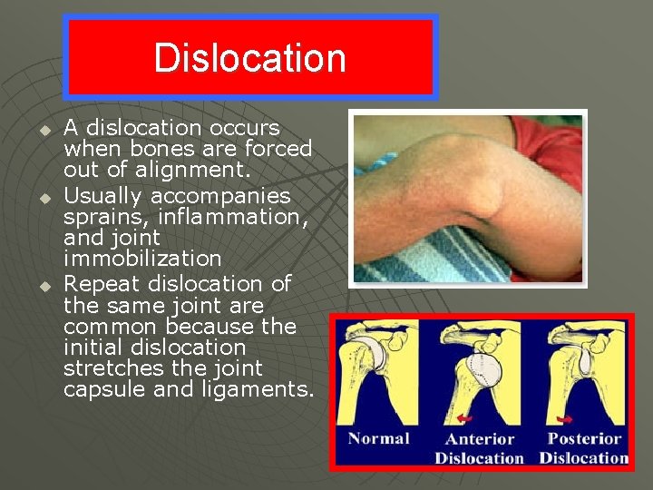 Dislocation u u u A dislocation occurs when bones are forced out of alignment.