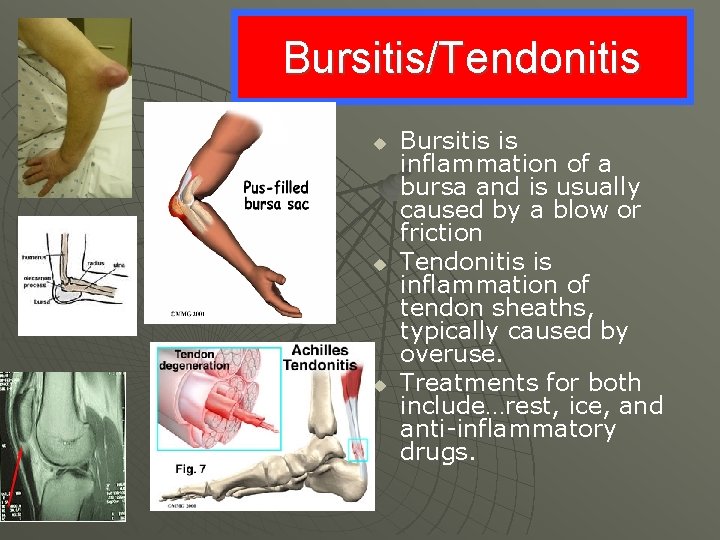 Bursitis/Tendonitis u u u Bursitis is inflammation of a bursa and is usually caused