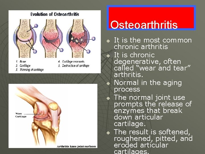 Osteoarthritis u u u It is the most common chronic arthritis It is chronic