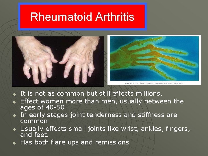 Rheumatoid Arthritis u u u It is not as common but still effects millions.