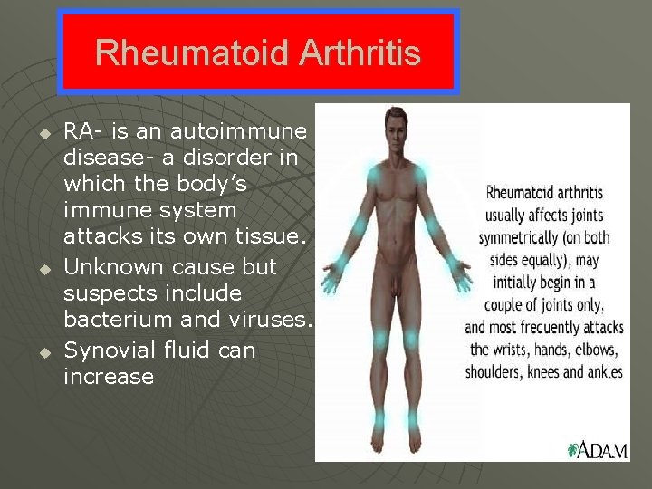Rheumatoid Arthritis u u u RA- is an autoimmune disease- a disorder in which