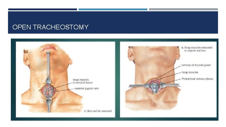 OPEN TRACHEOSTOMY 