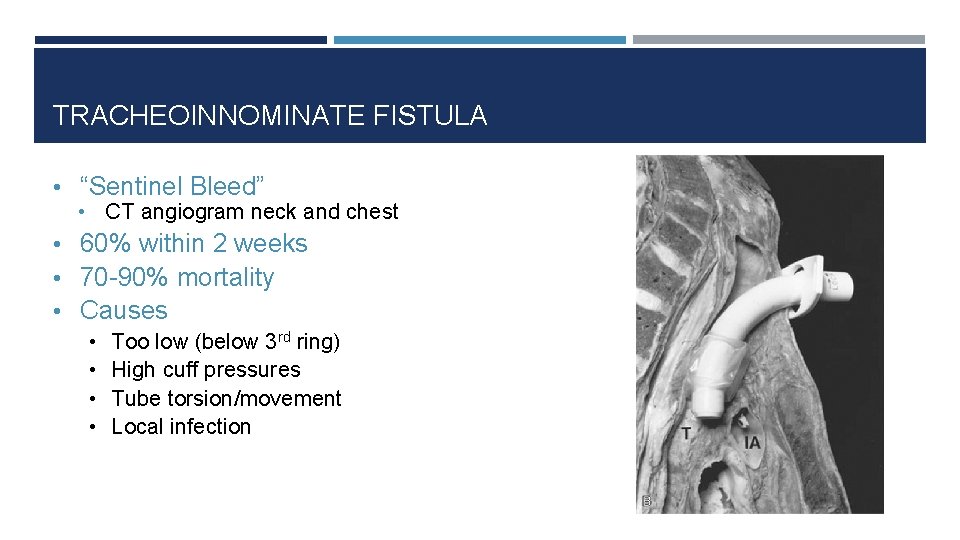 TRACHEOINNOMINATE FISTULA • “Sentinel Bleed” • CT angiogram neck and chest • 60% within